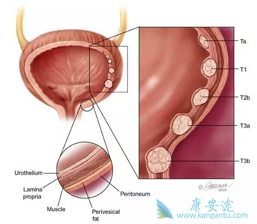 晚期尿路上皮癌 晚期尿路上皮癌