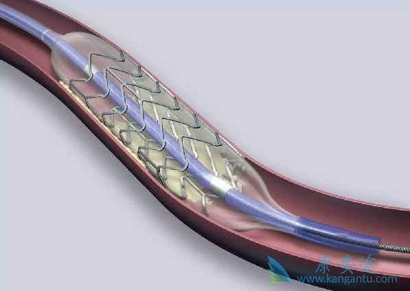心脏支架 心脏支架