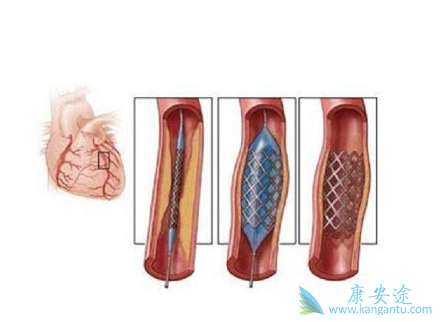 心脏支架 心脏支架