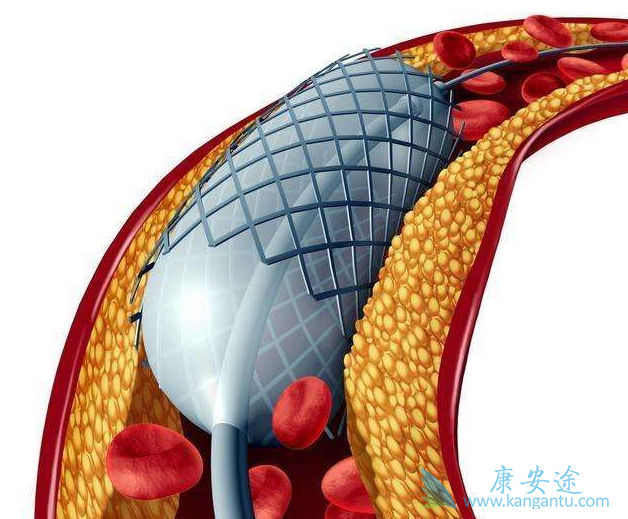 心血管支架 心血管支架