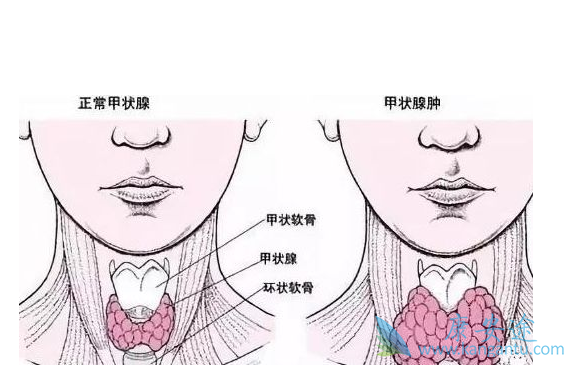 甲状腺肿瘤 甲状腺肿瘤