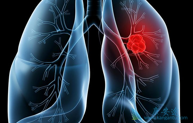 晚期肺癌 晚期肺癌