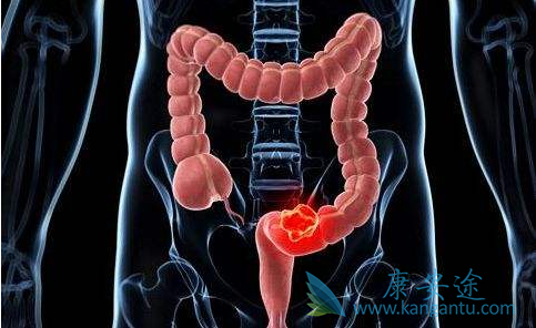 结直肠癌 结直肠癌
