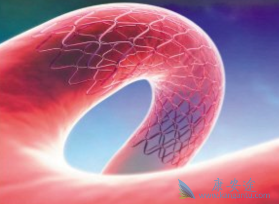 心脏支架 心脏支架