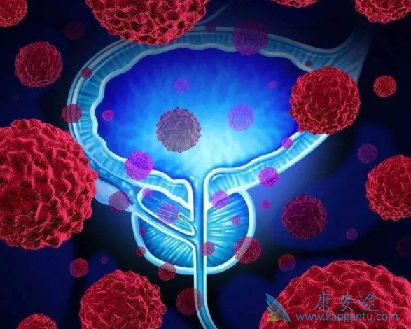 膀胱癌的早期症状 膀胱癌的早期症状