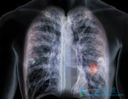 晚期非小细胞肺癌 晚期非小细胞肺癌