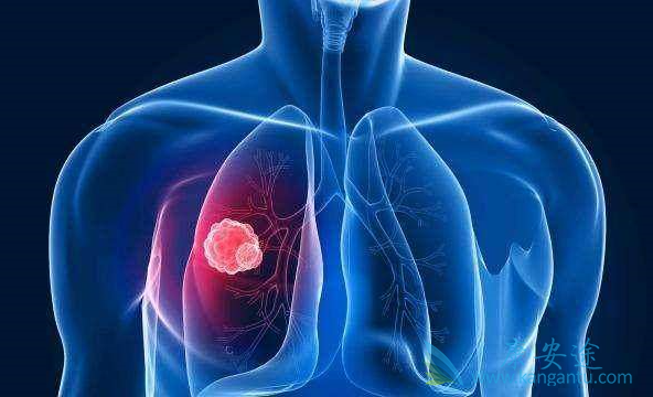 治疗肺癌 治疗肺癌