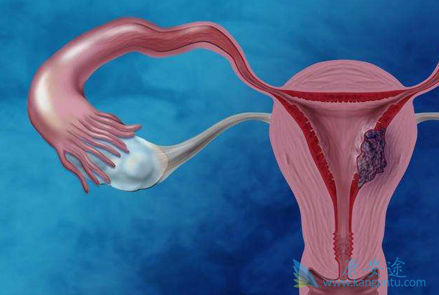 子宫癌的原因 子宫癌的原因