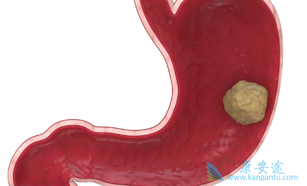 晚期胃癌 晚期胃癌