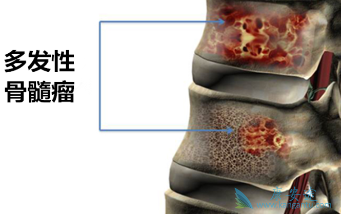 多发性骨髓瘤 多发性骨髓瘤