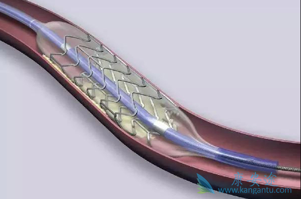 心脏支架 心脏支架