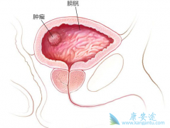 ����ҽ�Ʒ����׸����ڰ��װ����Ƶİ���ҩ��Balversa����Ч���