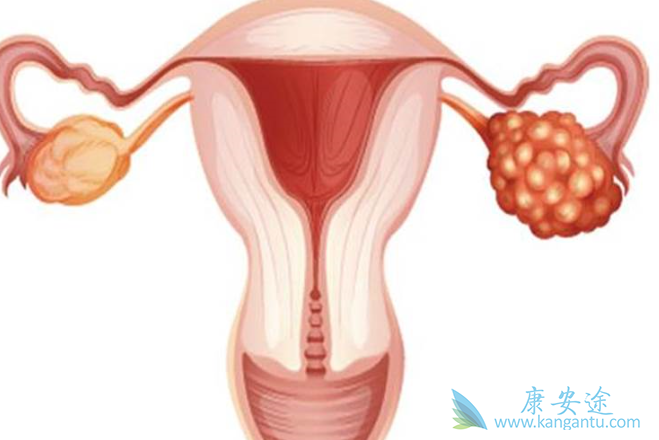 卵巢癌分期 卵巢癌分期