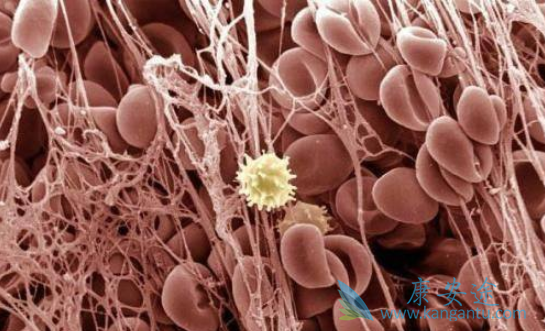 骨髓纤维化 骨髓纤维化