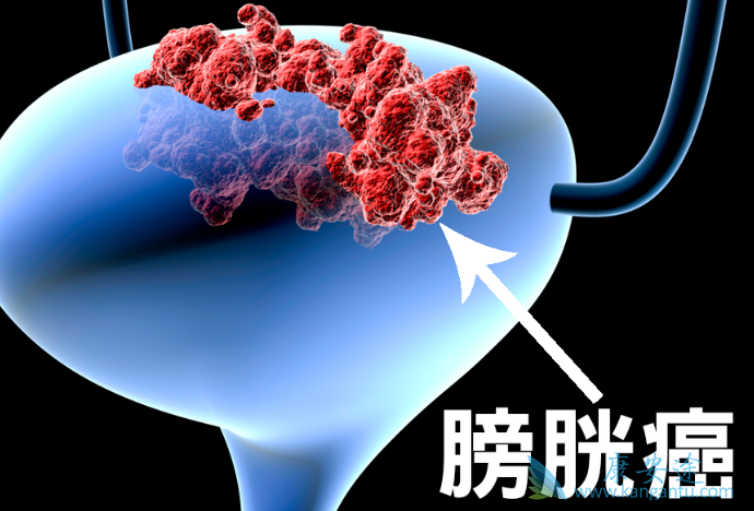 膀胱癌症状 膀胱癌症状