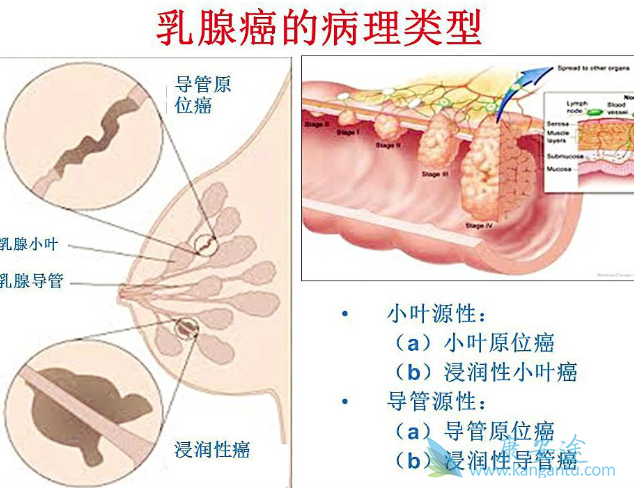 三阴性乳腺癌 三阴性乳腺癌