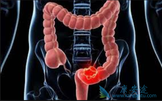结直肠癌 结直肠癌