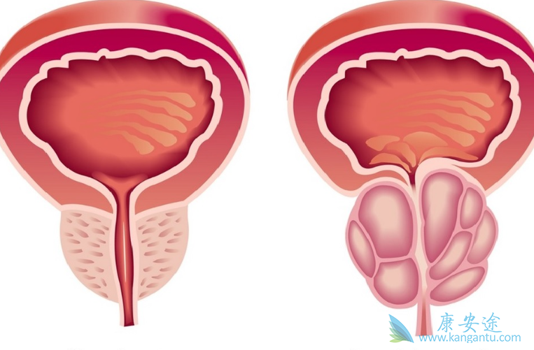 前列腺癌症 前列腺癌症