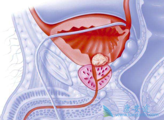 前列腺癌的治疗 前列腺癌的治疗