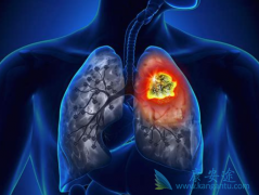 Keytruda���ϻ��ƶԷΰ���������Ч�ʿɴ�55%