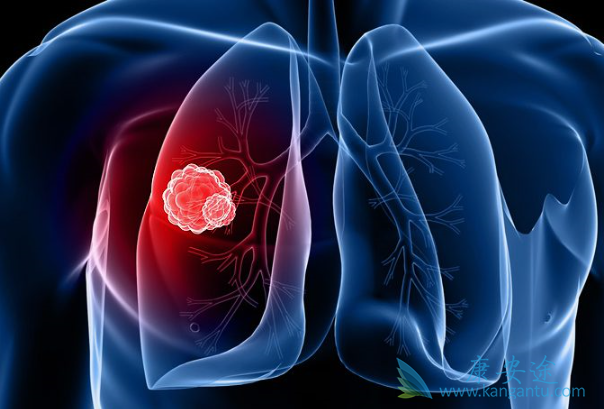 治疗肺癌 治疗肺癌
