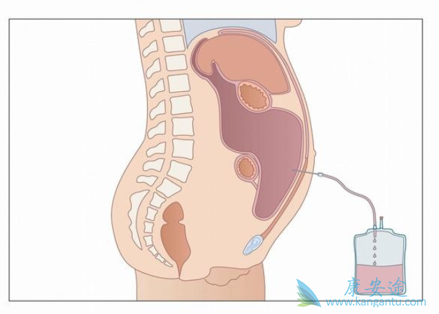 肝腹水晚期症状 肝腹水晚期症状