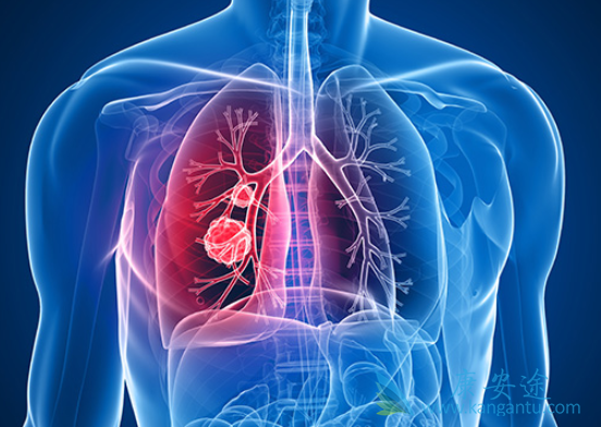 肺癌的晚期症状 肺癌的晚期症状