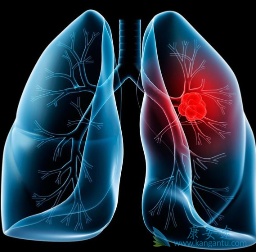 得了肺癌怎么治 得了肺癌怎么治