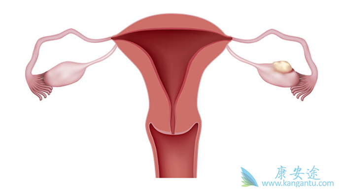 卵巢癌分期 卵巢癌分期