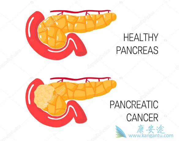 胰腺癌能活多久 胰腺癌能活多久