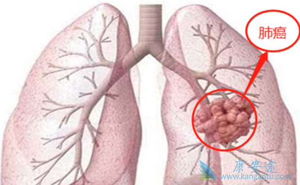 什么是非小细胞肺癌 什么是非小细胞肺癌