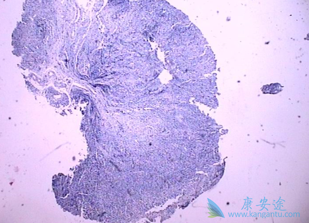 低分化腺癌能活多久 低分化腺癌能活多久