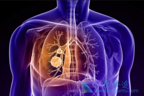 肺癌转移 肺癌转移