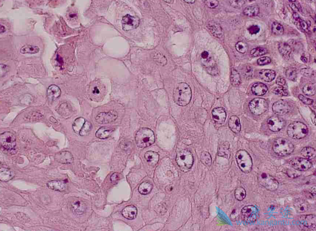 中分化鳞癌 中分化鳞癌