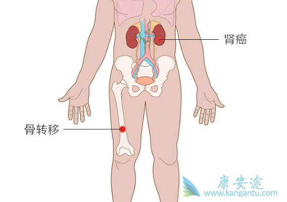 肿瘤骨转移 肿瘤骨转移