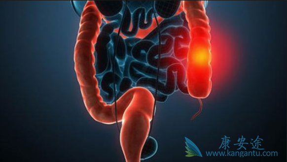 结直肠癌 结直肠癌