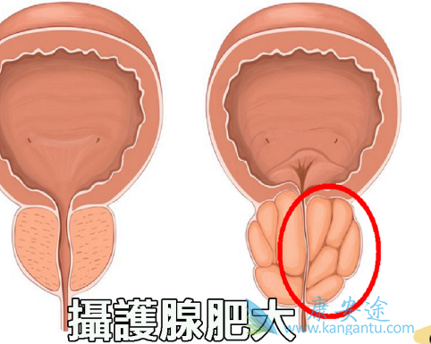 摄护腺癌 摄护腺癌