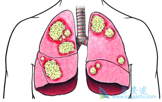 肺癌晚期有治好的吗 肺癌晚期有治好的吗