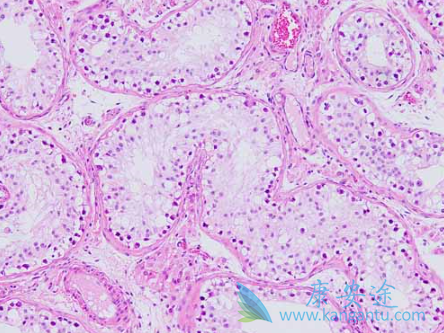 低分化腺癌能治好吗 低分化腺癌能治好吗