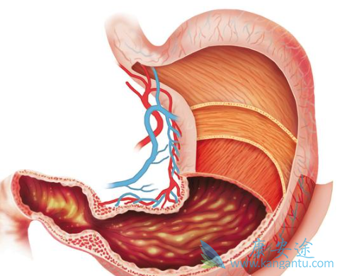 低分化腺癌胃癌 低分化腺癌胃癌