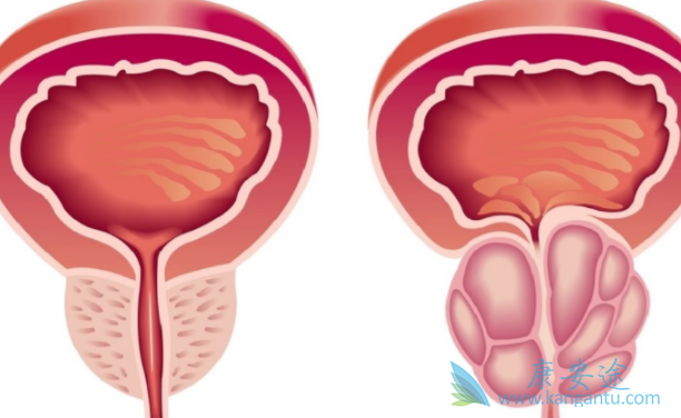 前列腺癌骨转移 前列腺癌骨转移
