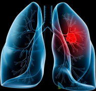 �ΰ���ת�Ƶ����ƺ�֢״����