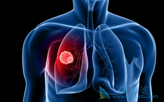 肺癌鳞癌 肺癌鳞癌