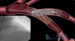 哪些患者比较适合做心脏支架手术？