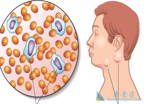 霍奇金淋巴瘤 霍奇金淋巴瘤
