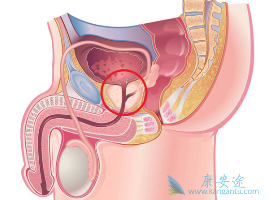 前列腺癌症状 前列腺癌症状