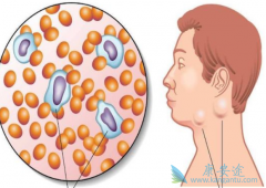 �ǻ�����ܰ�����֢״��������Щ��