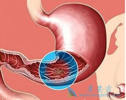 胃肠道间质瘤 胃肠道间质瘤