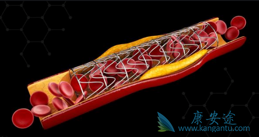 心脏支架 心脏支架