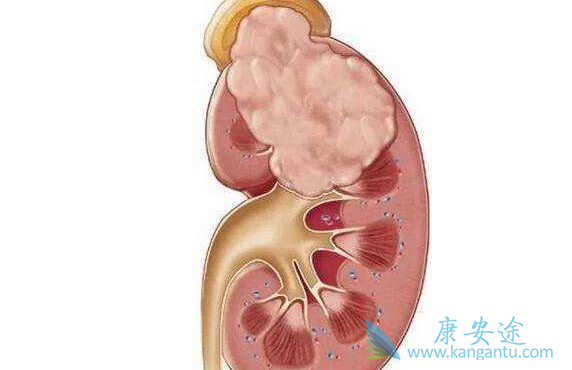 肾癌转移 肾癌转移